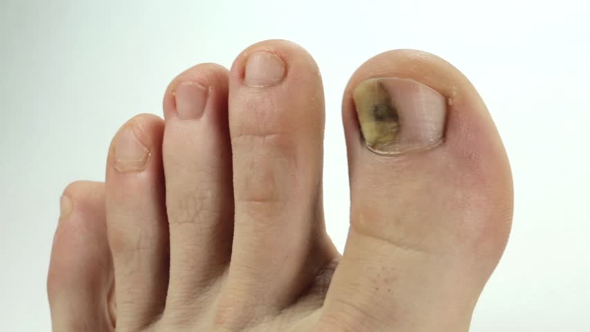 toenails-with-fungal-infection-sick-nail-fungus-of-big-toe-trauma-of