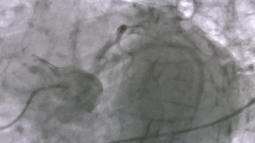 Coronary angiogram