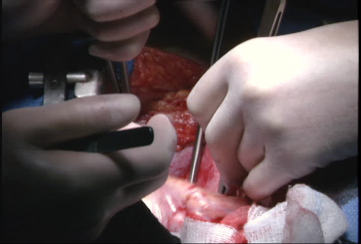 Beating heart during surgery