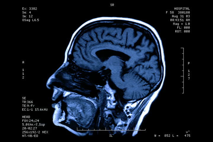 MRI Headache