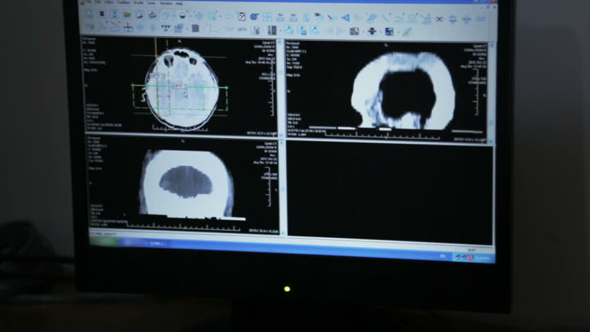 Doctor using medical software to analyze brain patient