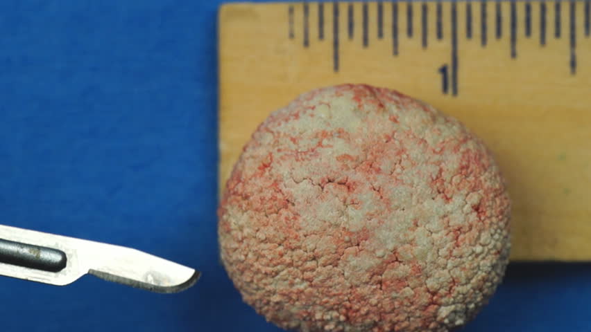 Veterinarian removing extremely large Bladder stone in a dog, calcium oxalate stone due to excessive calcium in diet