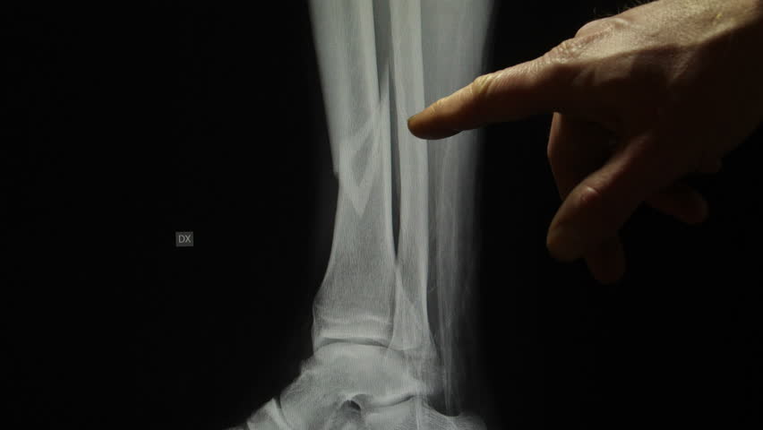 Header of fracture