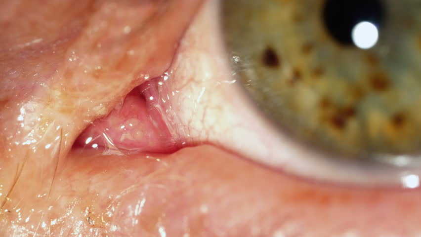 Header of punctum