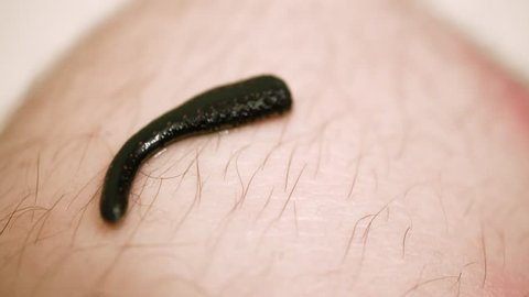 Treatment Leeches Feet Hirudotherapy Clinic Leech Stock Footage Video (100% Royalty-free) 1014390956 | Shutterstock Treatment Leeches Feet Hirudotherapy Clinic Leech Stock Footage Video (100% Royalty-free) 1014390956 | Shutterstock