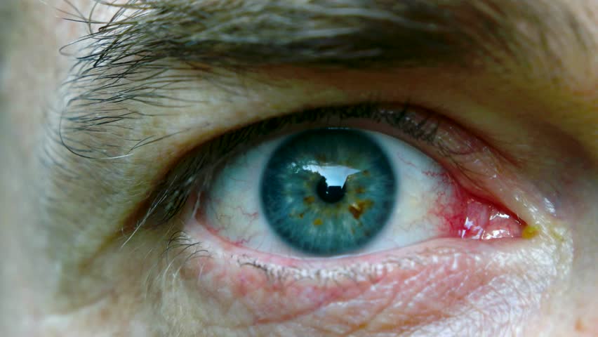 Header of pinkeye