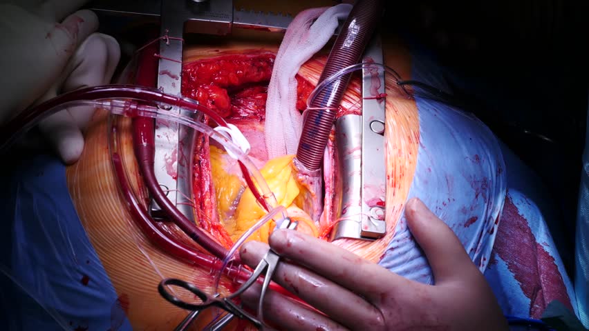 heart 9 surgery bypass 4K Graft Surgery. Of Coronary Closeup, View Artery Bypass