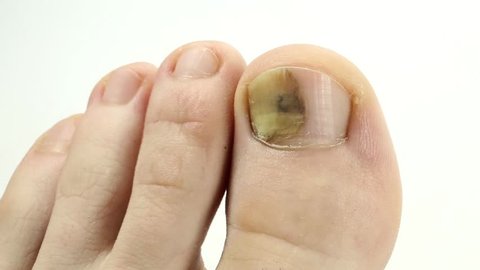 Trauma Of Toenail Toenails With Stock Footage Video 100 Royalty Free Shutterstock