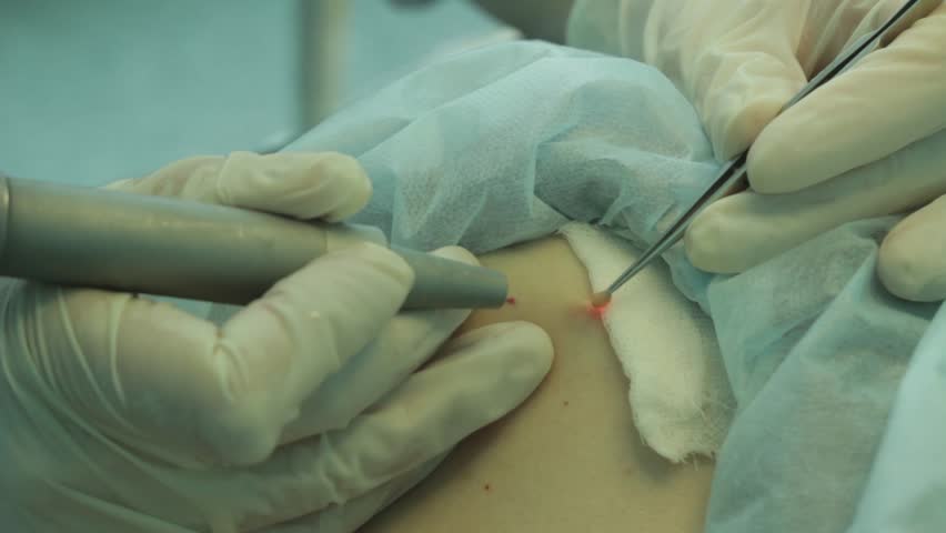 Header of Wart