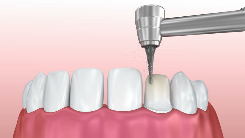 Header of veneer