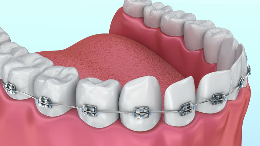 High Quality 3D Animation Showing The Installation Process Of Dental ...