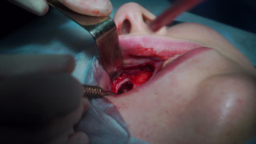 Header of maxillary