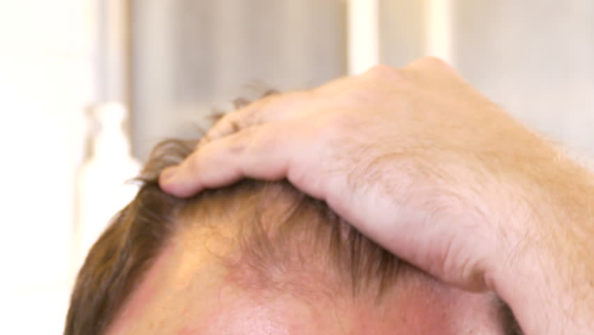 Man Strokes Receding Hairline Closeup Stock Footage Video 100