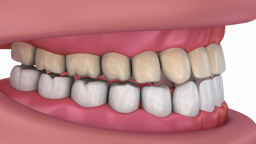 teeth becoming see through