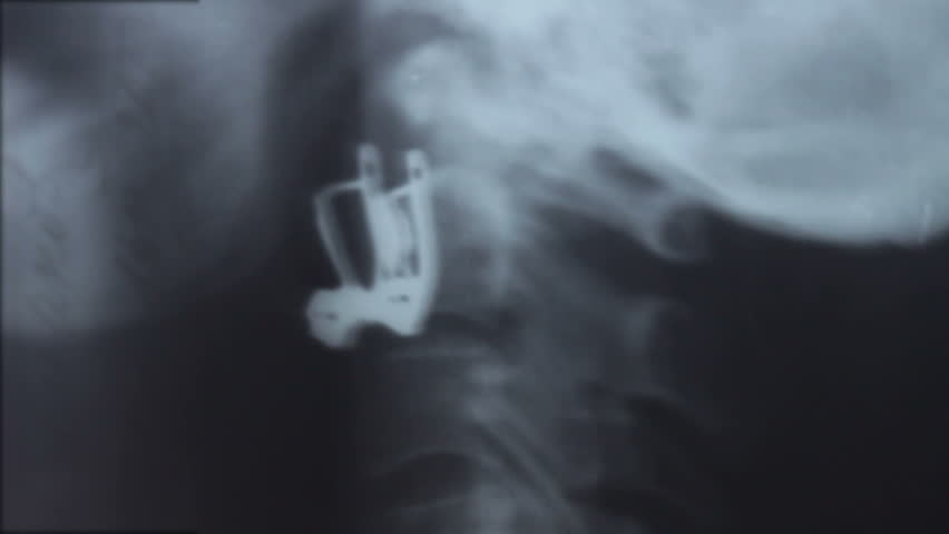 Header of cervical